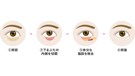目の下の切らないクマ取り・たるみ取り（脱脂）